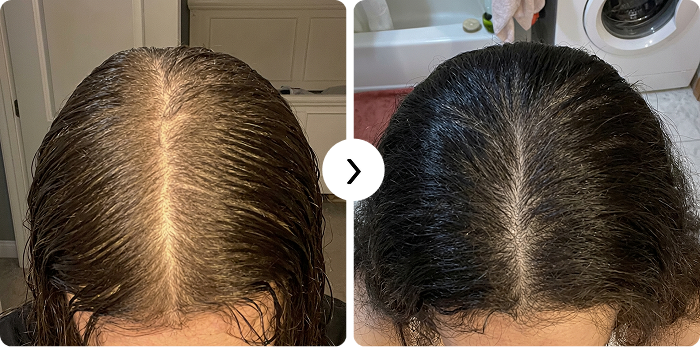 Hair regrowth before and after